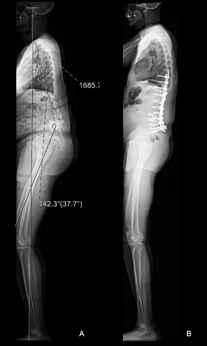 Full body EOS x-ray image of a man before and after ALIF surgery for flatback syndrome (FBS)